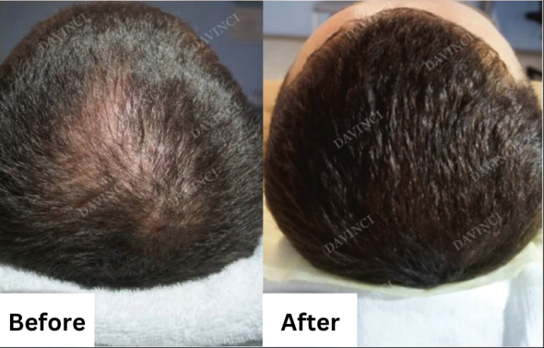 DV Hair Loss Before & After 2